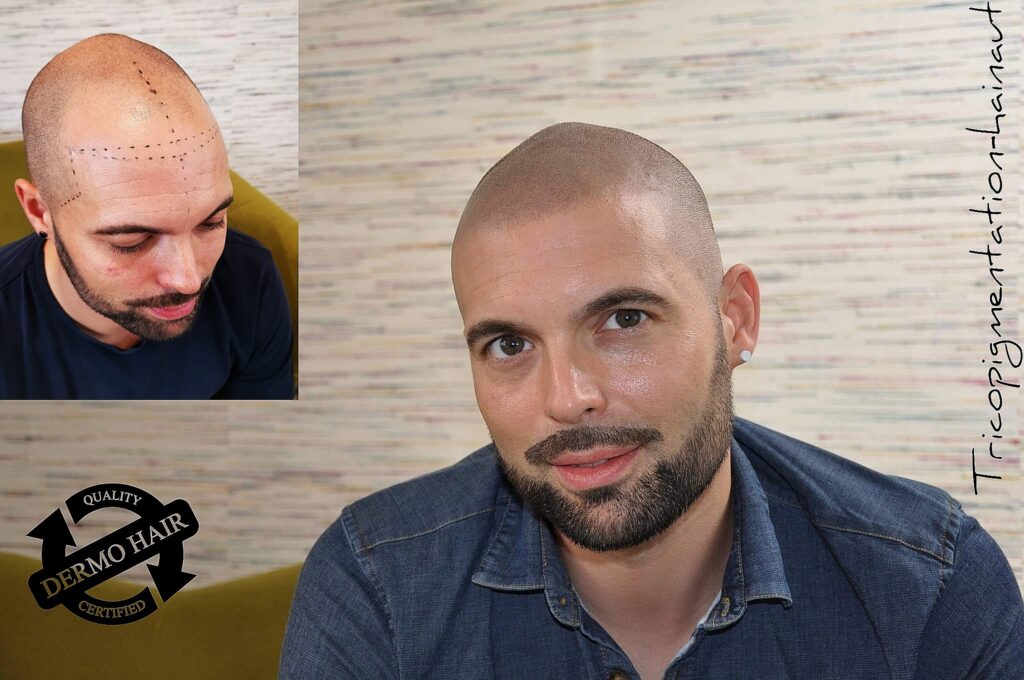 Micropigmentation effet rasé hyper réaliste.
